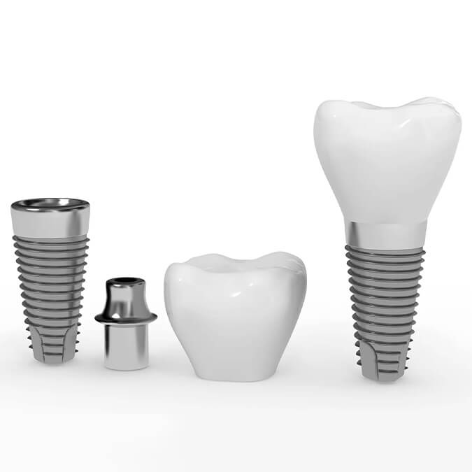 Implante dental
