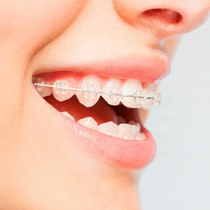 Usuaria brackets de zafiro