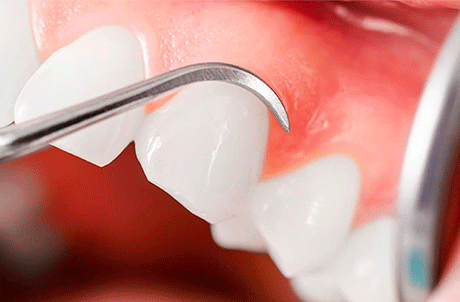Periodoncia