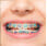 Brackets metálico con ligadura de colores