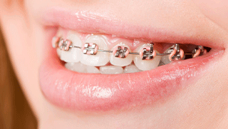 Brackets metálicos