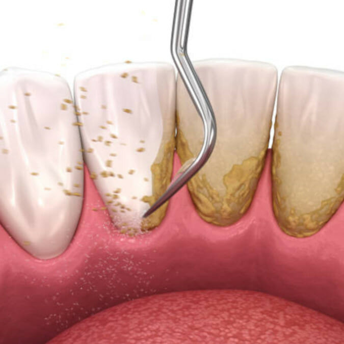 Limpieza de sarro dental