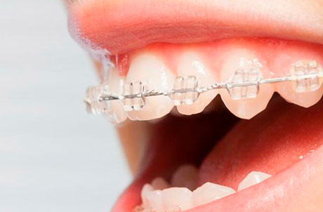 Brackets de zafiro