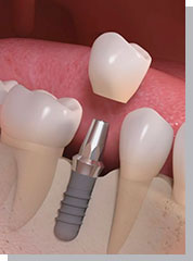 Implante dental, prótesis fija